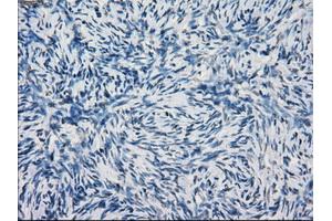 Immunohistochemical staining of paraffin-embedded Adenocarcinoma of breast tissue using anti-KDM4C mouse monoclonal antibody. (KDM4C antibody)