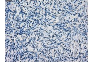 Immunohistochemical staining of paraffin-embedded Adenocarcinoma of breast tissue using anti-KDM4C mouse monoclonal antibody.