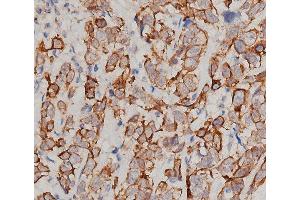 ABIN6276358 at 1/200 staining human breast cancer tissue sections by IHC-P. (IL-6 antibody  (Internal Region))