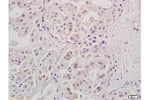 Formalin-fixed and paraffin embedded human ovary carcinoma labeled with Anti-Stra8, Unconjugated (ABIN736133) at 1:800, followed by conjugation to the secondary antibody and DAB staining. (STRA8 antibody  (AA 201-300))