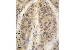 Formalin-fixed and paraffin-embedded human hepatocarcinoma tissue reacted with ADK antibody (C-term) (ABIN391132 and ABIN2841255) , which was peroxidase-conjugated to the secondary antibody, followed by DAB staining. (ADK antibody  (C-Term))