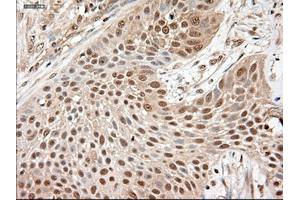 Immunohistochemical staining of paraffin-embedded Adenocarcinoma of breast using anti-NTF3 (ABIN2452548) mouse monoclonal antibody. (Neurotrophin 3 antibody  (AA 139-257))