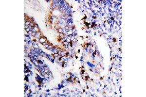 Anti-Bcl-XS antibody, IHC(P) IHC(P): Human Colon Cancer Tissue (BCL2L1 antibody  (Middle Region))