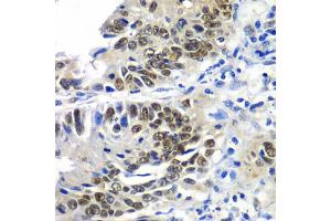 Immunohistochemistry of paraffin-embedded human colon carcinoma using DACH1 antibody (ABIN5972012) at dilution of 1/100 (40x lens). (DACH1 antibody)