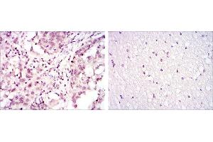 Immunohistochemical analysis of paraffin-embedded lung cancer (left) and brain tissues (right) using ATF2 mouse mAb with DAB staining.