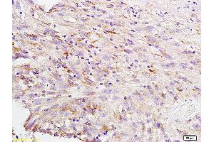 Formalin-fixed and paraffin embedded human brain glioblastoma labeled with Anti-CA II Polyclonal Antibody, Unconjugated (ABIN733298) at 1:200 followed by conjugation to the secondary antibody and DAB staining (CA2 antibody  (AA 201-260))