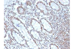 Formalin-fixed, paraffin-embedded human Colon Carcinoma stained with BMI1 Mouse Monoclonal Antibody (BMI1/2690). (BMI1 antibody  (AA 142-326))