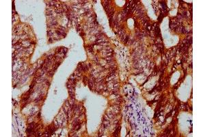 IHC image of ABIN7150800 diluted at 1:500 and staining in paraffin-embedded human colon cancer performed on a Leica BondTM system. (Dymeclin antibody  (AA 224-348))