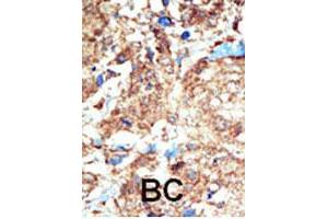Formalin-fixed and paraffin-embedded human cancer tissue reacted with the primary antibody, which was peroxidase-conjugated to the secondary antibody, followed by DAB staining. (EPH Receptor B1 antibody  (C-Term))