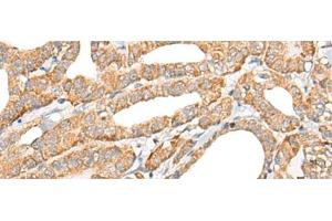 Immunohistochemistry of paraffin-embedded Human thyroid cancer tissue using CCL5 Polyclonal Antibody at dilution of 1:50(x200) (CCL5 antibody)