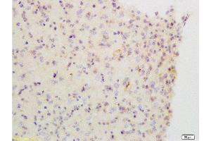 Formalin-fixed and paraffin embedded: Human brain glioma labeled with Anti-ChRM2 Polyclonal Antibody, Unconjugated  at1:200, followed by conjugation to the secondary antibody and DAB staining (Muscarinic Acetylcholine Receptor M2 antibody  (AA 381-466))