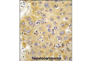 Formalin-fixed and paraffin-embedded human hepatocarcinoma tissue reacted with CTGF antibody , which was peroxidase-conjugated to the secondary antibody, followed by DAB staining.