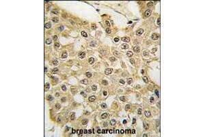 Formalin-fixed and paraffin-embedded human breast carcinoma tissue reacted with the MDM2 Antibody (S166) , which was peroxidase-conjugated to the secondary antibody, followed by DAB staining. (MDM2 antibody  (AA 141-176))