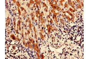 Immunohistochemistry analysis of human liver cancer using ABIN7147768 at dilution of 1:100 (CFAP61 antibody  (AA 1-200))