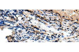 Immunohistochemistry of paraffin-embedded Human lung cancer tissue using CSRP3 Polyclonal Antibody at dilution of 1:40(x200) (CSRP3 antibody)