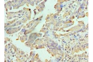 Immunohistochemistry of paraffin-embedded human lung cancer using ABIN7167113 at dilution of 1:100 (RICTOR antibody  (AA 1-245))