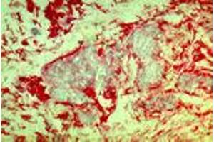 Invasive mammary carcinoma cells (MAb DF5, b1-Integrin) (ITGB1 antibody)