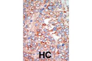Formalin-fixed and paraffin-embedded human hepatocellular carcinoma tissue reacted with the STK24 polyclonal antibody  , which was peroxidase-conjugated to the secondary antibody, followed by AEC staining. (STK24 antibody  (C-Term))