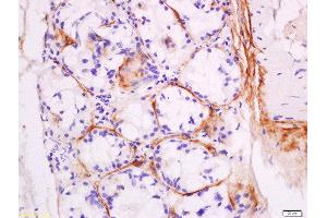 Formalin-fixed and paraffin embedded human laryngocarcinoma labeled with Anti-DNase II Polyclonal Antibody, Unconjugated  at 1:200 followed by conjugation to the secondary antibody and DAB staining.