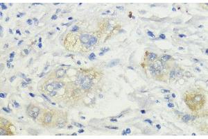 Immunohistochemistry of paraffin-embedded Human liver cancer using SURF4 Polyclonal Antibody at dilution of 1:200 (40x lens). (Surfeit 4 antibody)