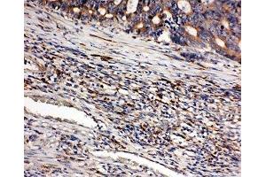IHC-P: CD163 antibody testing of human intestinal cancer tissue (CD163 antibody  (AA 1056-1165))