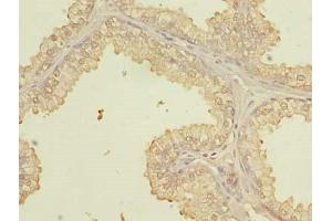 Immunohistochemistry of paraffin-embedded human prostate cancer using ABIN7164073 at dilution of 1:100 (PQLC3 antibody  (AA 118-170))