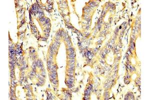 IHC image of ABIN7166908 diluted at 1:400 and staining in paraffin-embedded human colon cancer performed on a Leica BondTM system. (PKM antibody  (AA 185-461))