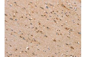 The image on the left is immunohistochemistry of paraffin-embedded Human brain tissue using ABIN7192440(SLC25A20 Antibody) at dilution 1/30, on the right is treated with synthetic peptide. (SLC25A2 antibody)