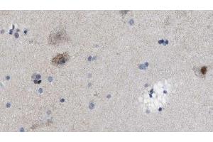 ABIN6269032 at 1/100 staining Human brain cancer tissue by IHC-P. (UCHL1 antibody  (C-Term))