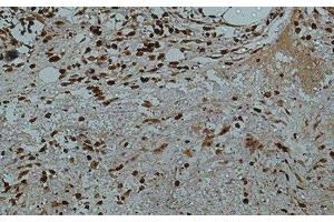 Immunohistochemistry of paraffin-embedded Human colon tissue using Galectin 3 Monoclonal Antibody at dilution of 1:50. (Galectin 3 antibody)