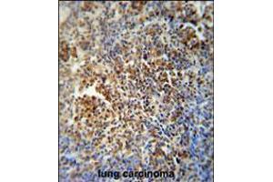 MAF1 antibody immunohistochemistry analysis in formalin fixed and paraffin embedded human lung carcinoma followed by peroxidase conjugation of the secondary antibody and DAB staining. (MAF1 antibody  (AA 90-117))