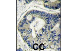 Formalin-fixed and paraffin-embedded human colon carcinoma reacted with AKT2 polyclonal antibody  , which was peroxidase-conjugated to the secondary antibody, followed by DAB staining .