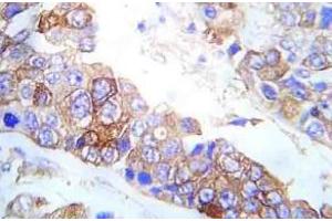 Immunohistochemistry analysis of Fyn antibody pTyr530 in paraffin-embedded Human breast carcinoma tissue. (FYN antibody  (pTyr530))