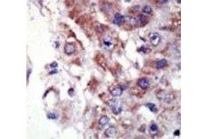 IHC analysis of FFPE human hepatocarcinoma tissue stained with the JNK2 antibody (JNK2 antibody  (AA 349-379))