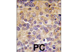 Formalin-fixed and paraffin-embedded human prostate carcinoma tissue reacted with PRMT3 polyclonal antibody  , which was peroxidase-conjugated to the secondary antibody, followed by DAB staining. (PRMT3 antibody  (N-Term))