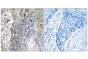 Immunohistochemistry analysis of paraffin-embedded human lung carcinoma tissue, using SLC28A2 antibody. (SLC28A2 antibody  (Internal Region))