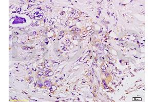 Formalin-fixed and paraffin embedded human colon carcinoma tissue labeled with Anti-Tsg101 Polyclonal Antibody (ABIN685507), Unconjugated at 1:200 followed by conjugation to the secondary antibody, (SP-0023), and DAB staining (TSG101 antibody  (AA 4-120))