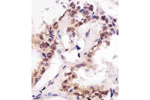 (ABIN387785 and ABIN2838022) staining SUMO1 in human lung adenocarcinoma tissue sections by Immunohistochemistry (IHC-P - paraformaldehyde-fixed, paraffin-embedded sections). (SUMO1 antibody)