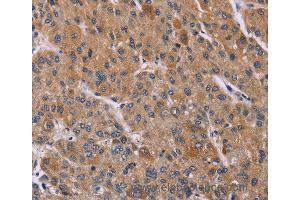 Immunohistochemistry of Human liver cancer using PPIF Polyclonal Antibody at dilution of 1:45 (PPIF antibody)