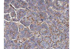 IHC-P Image MMP1 antibody detects MMP1 protein at secreted on human endometrial carcinoma by immunohistochemical analysis.