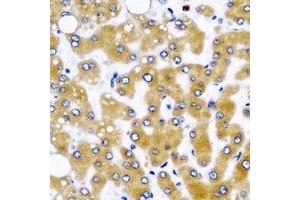 Immunohistochemical analysis of GLUD2 staining in human liver cancer formalin fixed paraffin embedded tissue section. (GLUD2 antibody)