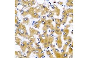 Immunohistochemical analysis of GLUD2 staining in human liver cancer formalin fixed paraffin embedded tissue section.