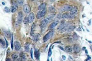 Immunohistochemistry (IHC) analyzes of p-Catenin-beta antibody in paraffin-embedded human colon carcinoma tissue. (CTNNB1 antibody  (pSer33))