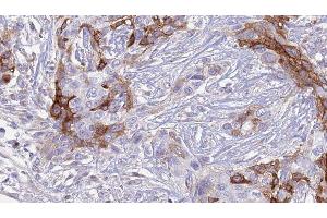 ABIN6277346 at 1/100 staining Human urothelial cancer tissue by IHC-P. (SLC18A2 antibody  (C-Term))