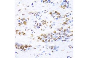 Immunohistochemistry of paraffin-embedded human breast cancer using XRCC5 Antibody. (XRCC5 antibody  (AA 543-732))