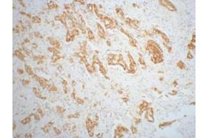 Immunohistochemistry (IHC) staining of Mouse prostate adenocarcinoma tissue, diluted at 1:200.
