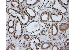 Immunohistochemical staining of paraffin-embedded Carcinoma of liver tissue using anti-NME4 mouse monoclonal antibody.