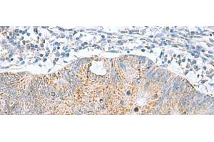 Immunohistochemistry of paraffin-embedded Human colorectal cancer tissue using GCSH Polyclonal Antibody at dilution of 1:60(x200)