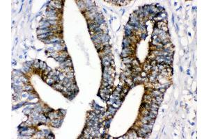 Anti- MAOA Picoband antibody,IHC(P) IHC(P): Human Intestinal Cancer Tissue (Monoamine Oxidase A antibody  (C-Term))