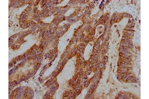 IHC image of ABIN7176254 diluted at 1:1000 and staining in paraffin-embedded human colon cancer performed on a Leica BondTM system. (TFF3 antibody  (AA 22-80))